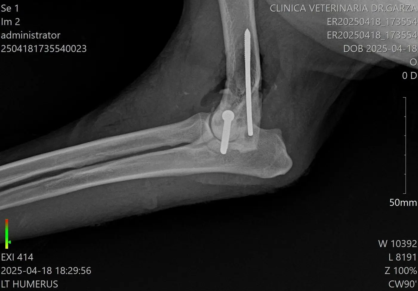 Radiografía digital de un húmero fijado con clavos
